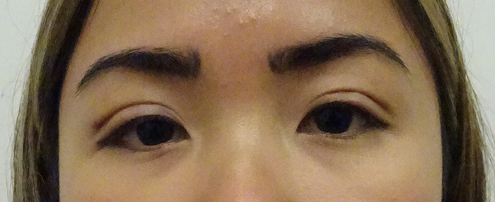 No Incision Double Eyelid Surgery Results Honolulu