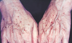 Hand Rejuvenation