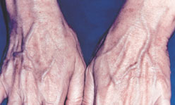 Hand Rejuvenation