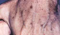 Hand Rejuvenation