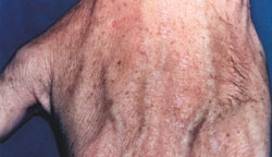 Hand Rejuvenation