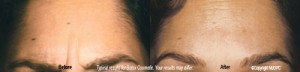 Botox Brow Lines Treatment