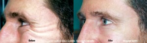 Botox Frown Lines Treatment