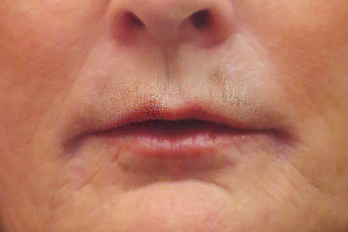 Lip Filler