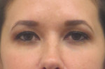 Botox Cosmetic and Dysport