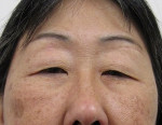 Blepharoplasty