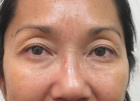 Blepharoplasty