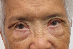 Blepharoplasty