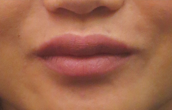 Lip Filler