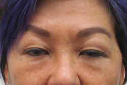 Blepharoplasty