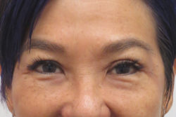 Blepharoplasty