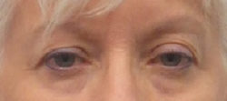 Blepharoplasty