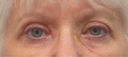 Blepharoplasty