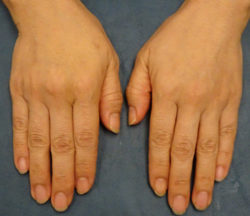 Hand Rejuvenation