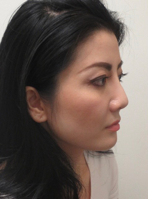 Non-Surgical Liquid Rhinoplasty