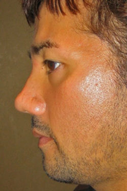 Non-Surgical Liquid Rhinoplasty