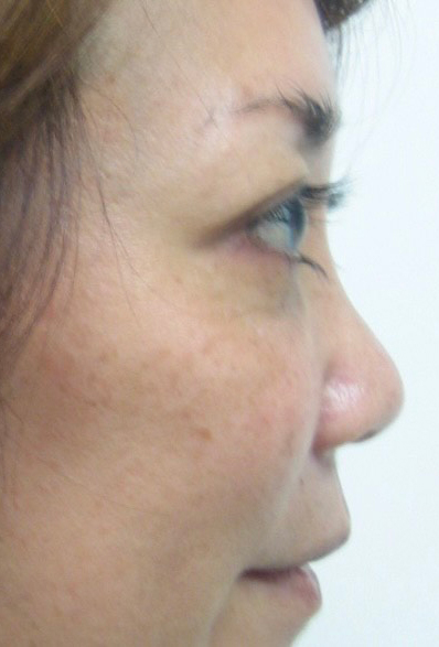 Non-Surgical Liquid Rhinoplasty