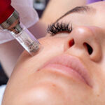 Microneedling facial therapy close up