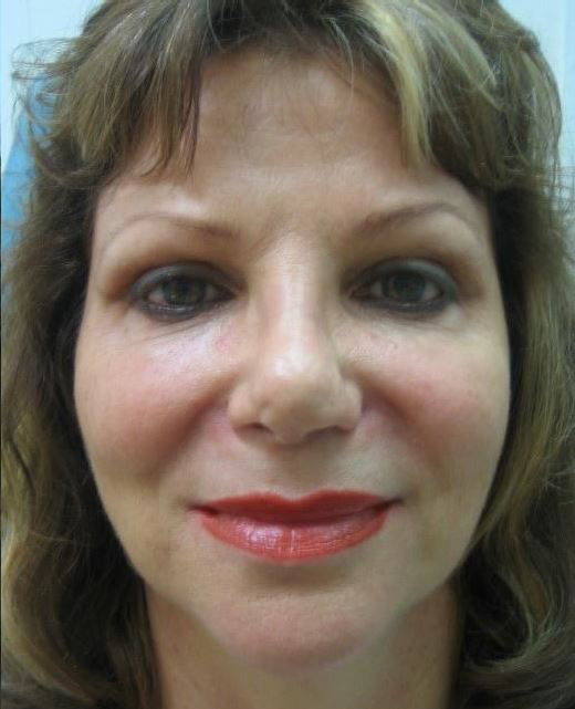 Liquid Facelift Before & After