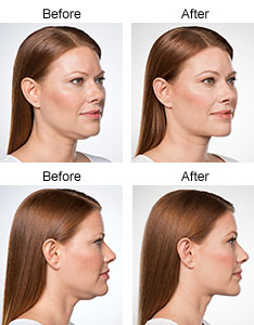 Kybella® Before & After