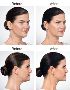 Kybella® Before & After
