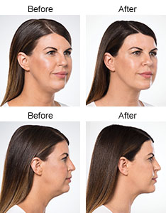 Kybella® Before & After