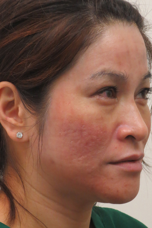 Skin Lasers and Other Procedures Results Honolulu