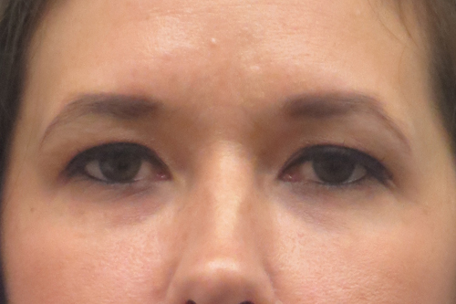 Botox Brow Lift Before & After