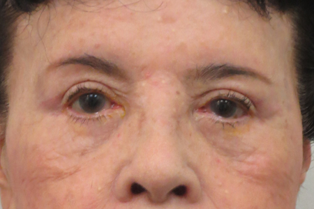 Eyelid Surgery Before & After