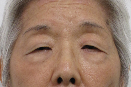 Eyelid Surgery Before & After