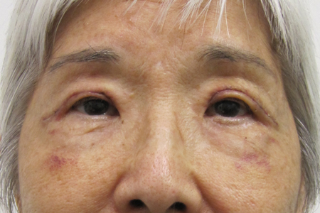 Eyelid Surgery Before & After