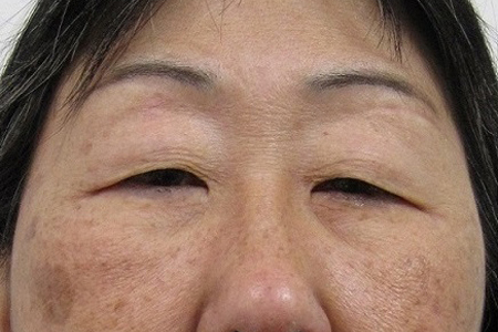 Eyelid Surgery Before & After