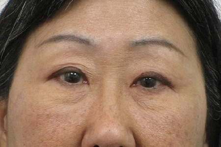 Eyelid Surgery Before & After