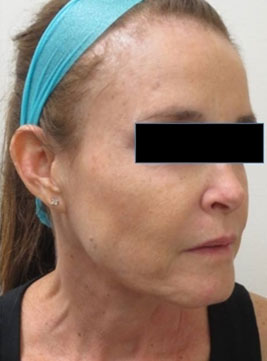 Sculptra Before & After