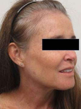 Sculptra Before & After