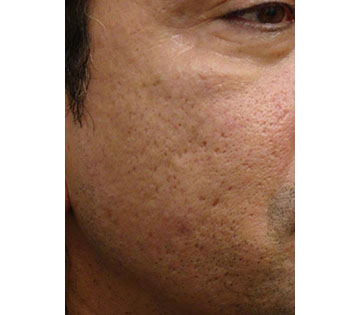 Madonna Lift - Skin Lasers and Other Procedures Results Honolulu