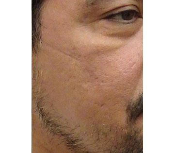 Skin Lasers and Other Procedures Results Honolulu