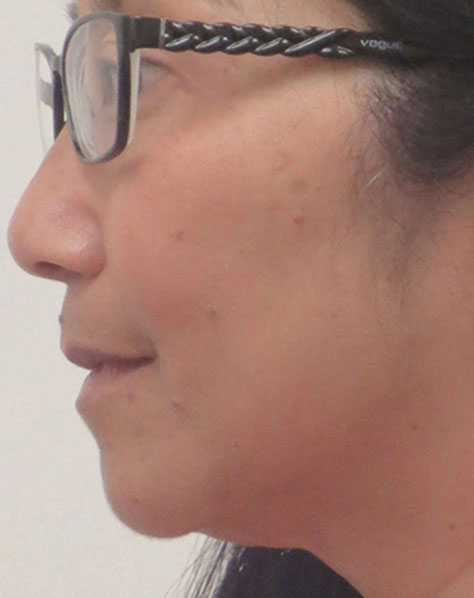 Kybella® Before & After