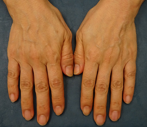 Hand Rejuventation Before