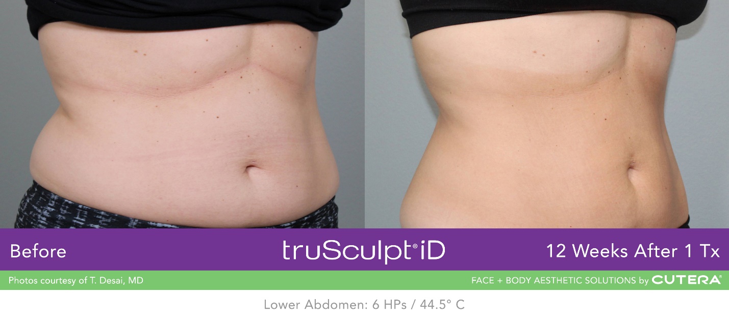 truSculpt iD Before & After