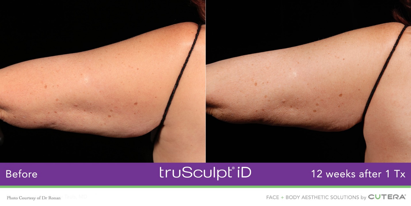 truSculpt iD Before & After