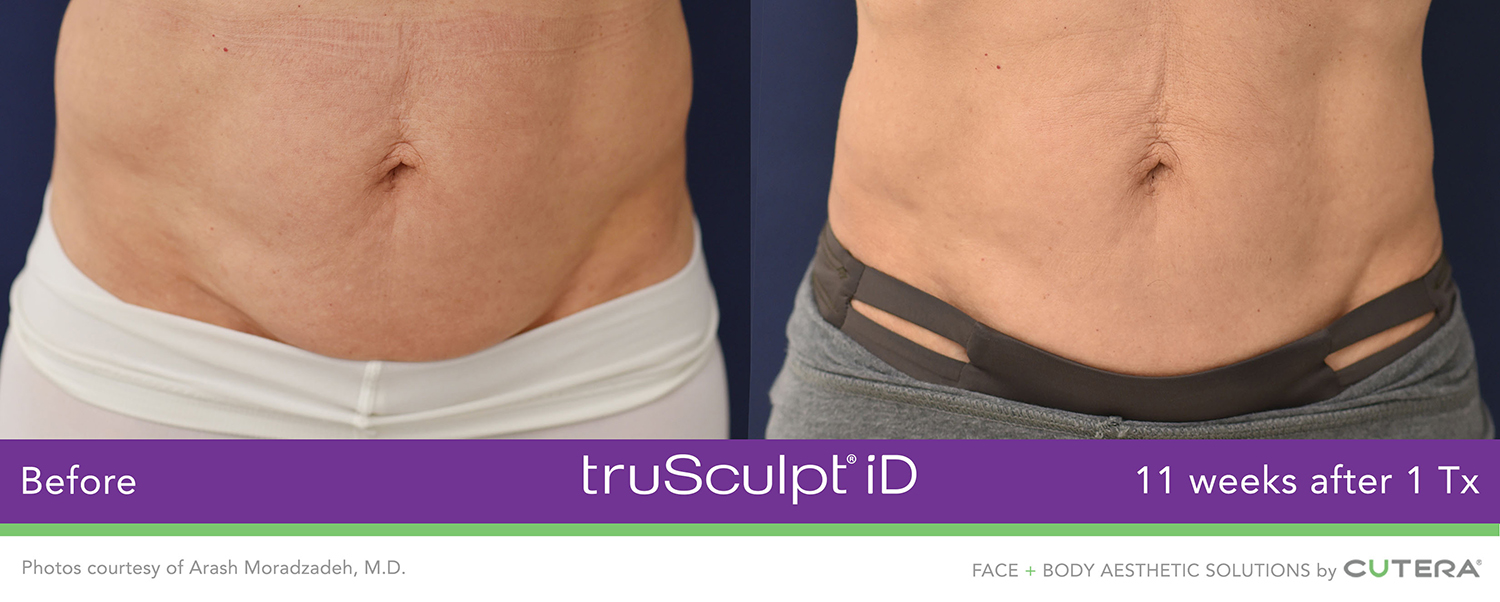 truSculpt iD Before & After