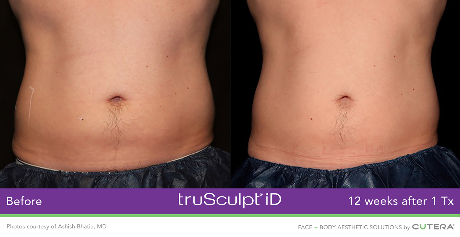 truSculpt iD Before & After