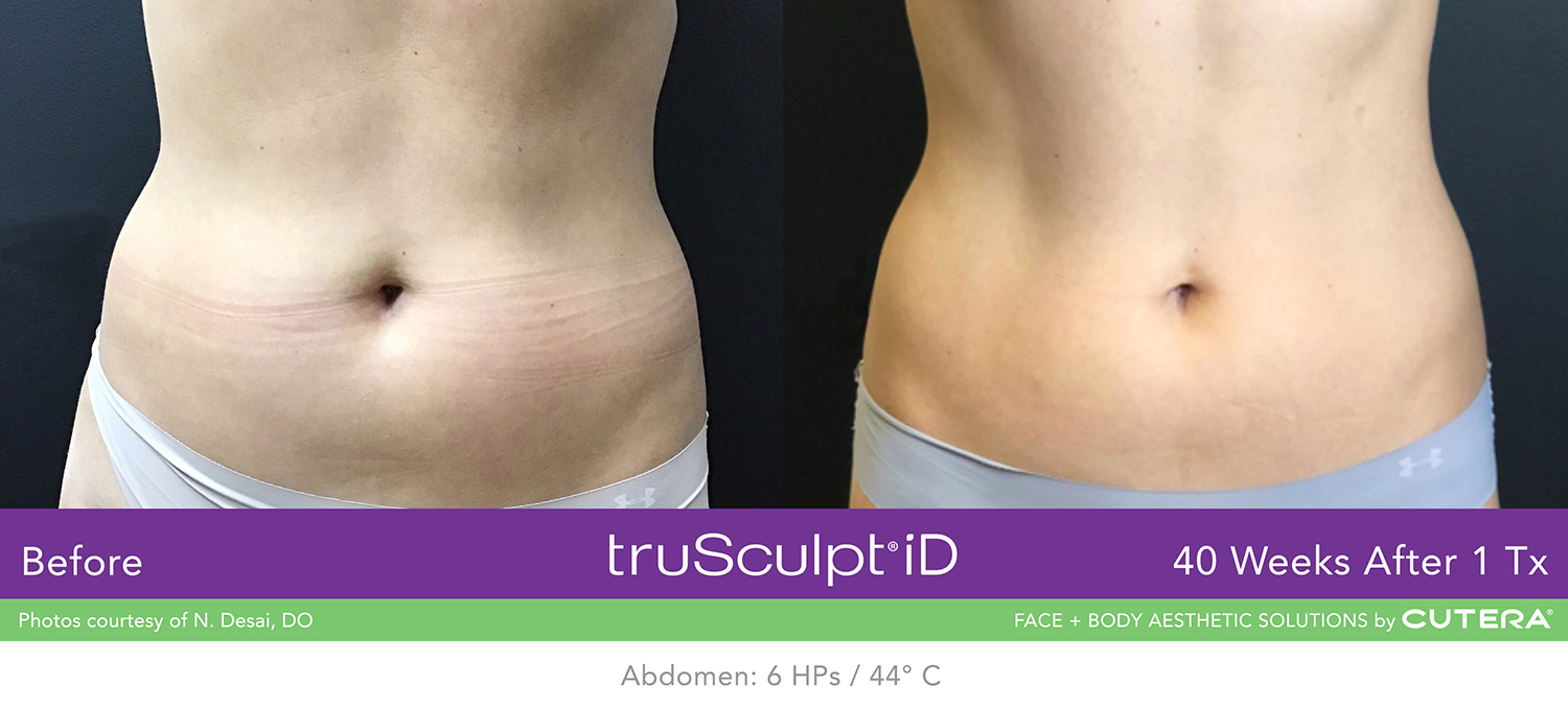 truSculpt iD Before & After