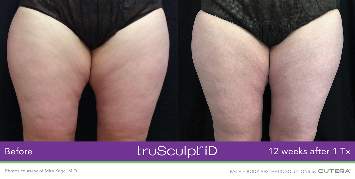 truSculpt iD Before & After