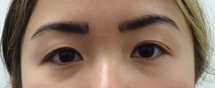 No Incision Double Eyelid Surgery Results Honolulu