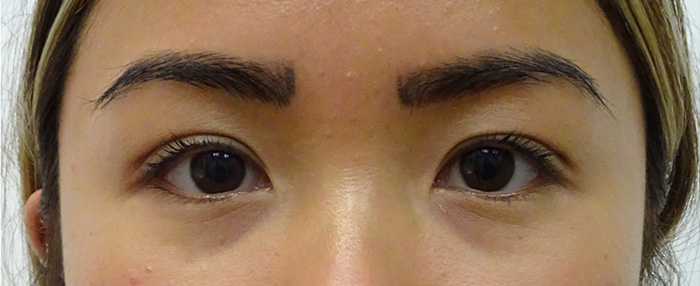 No Incision Double Eyelid Surgery Results Honolulu