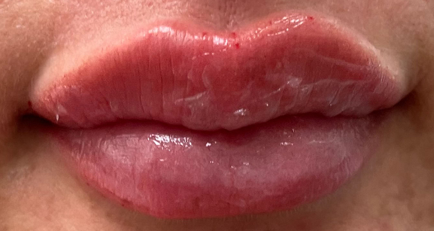 Lip Filler Before & After