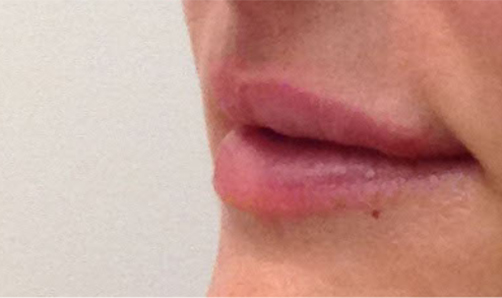Lip Filler Before & After